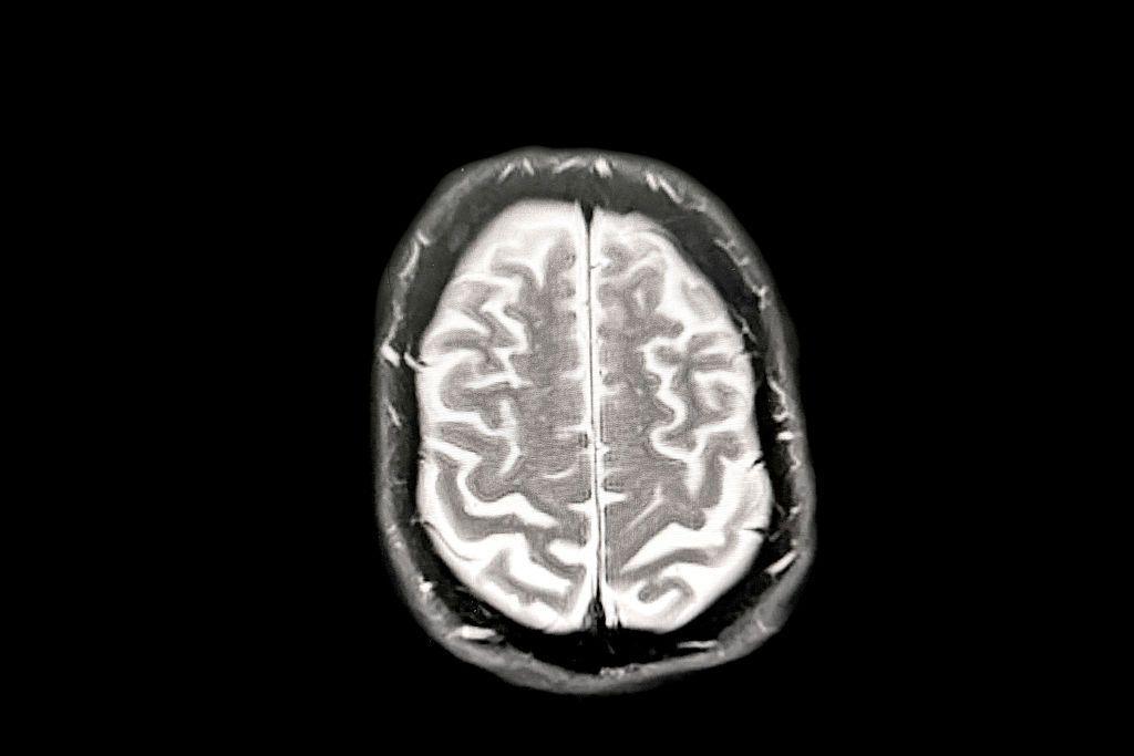 Image caption,A brain scan showing early Alzheimer's disease. The atlas could help scientists better understand Alzheimer's, Parkinson's disease and brain stroke