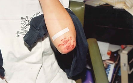 Grazes on the arm of Joanne Lees after her attempted abduction by Bradley Murdoch.Photograph: NT Police