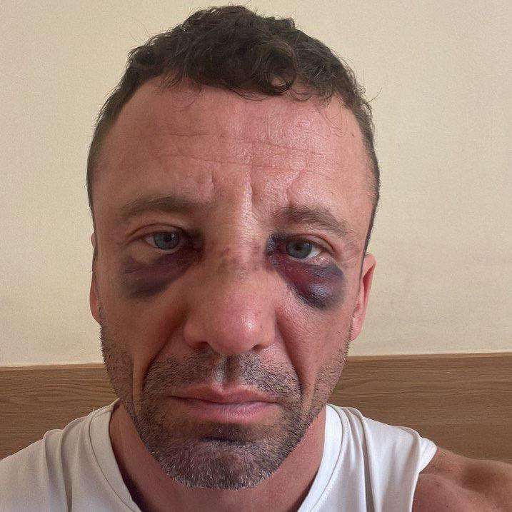Image caption,Kyrylo spent two weeks in hospital following the attack and has made formal official complaints