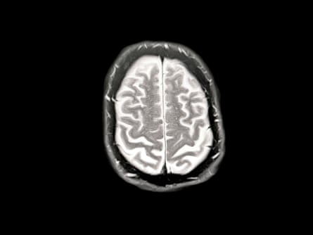 A scan of a brain showing early signs of Alzheimer’s.Photograph: Peter Dazeley