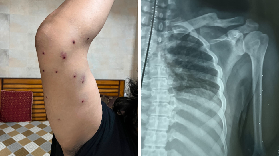 Image caption,A 28-year-old journalist, who did not want to be named, has shared his photos and X-ray with the BBC