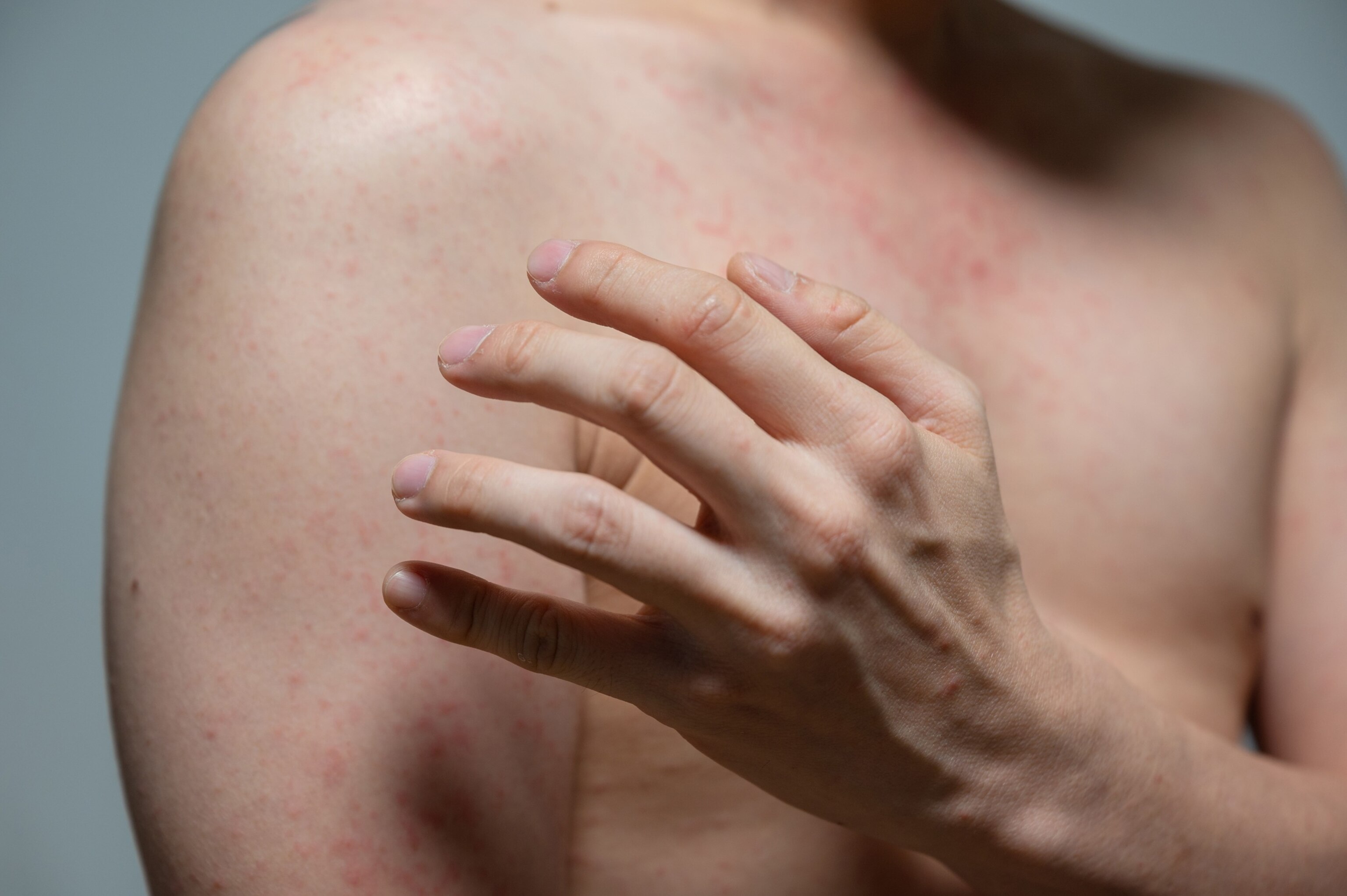 Stock photo of a person with the measles.Mumemories/Getty Images