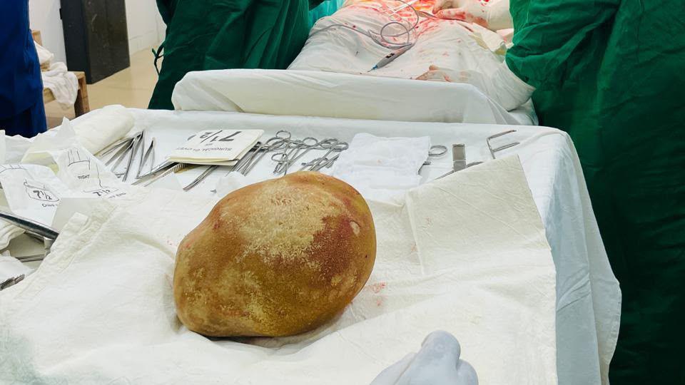 Image caption,The bladder stone was around 17cm-wide, the size of an ostrich egg