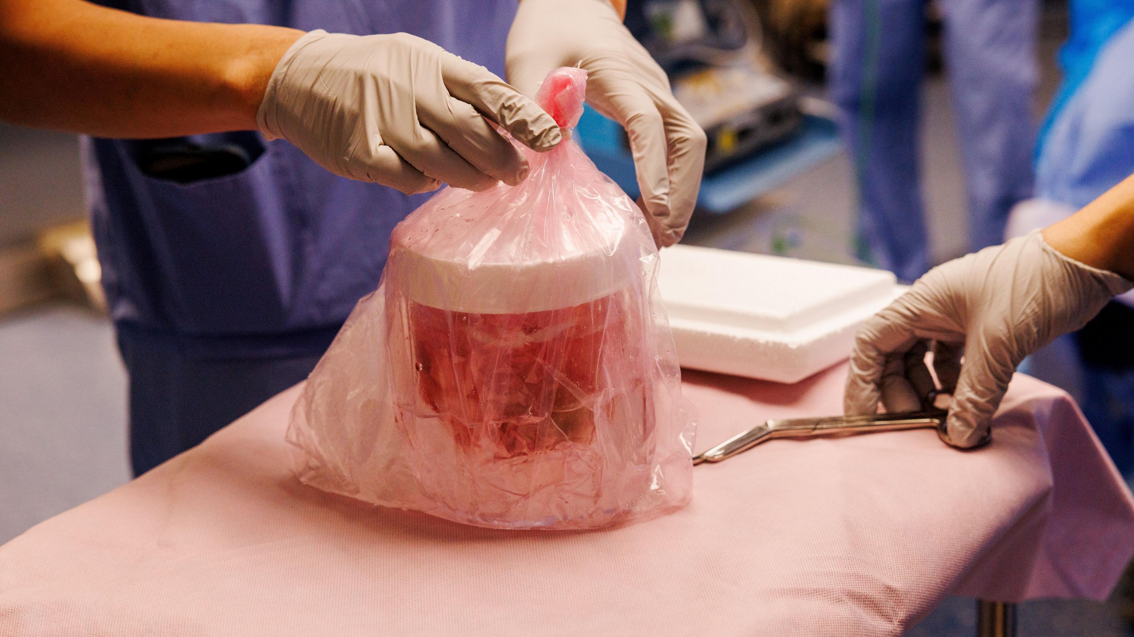 Image caption,The donor kidney had been harvested from a genetically modified pig to make it suitable for human donation